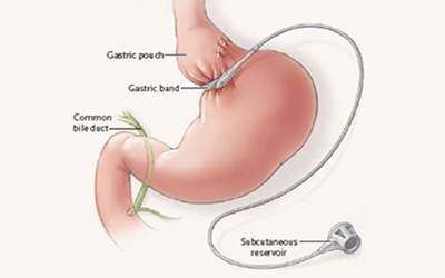 bariatric surgery20160910123258_l